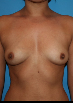 Breast Augmentation 4