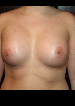 Breast Augmentation 6