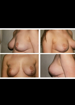 Breast Lift 3