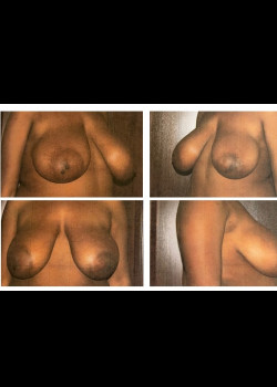Breast Lift 4