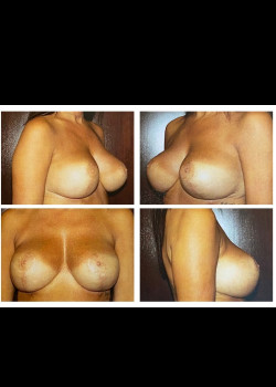 Breast Lift 6